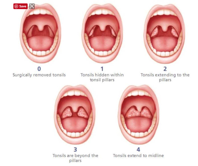What are the 4 grades of swollen tonsils